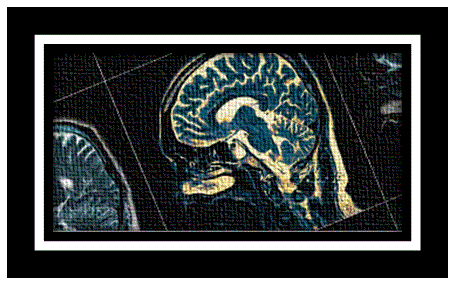 İMZA VE YAZIYI ETKİLEYEN FAKTÖRLER – Alzheimer Hastalığı
